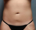Liposuction Case 3 After